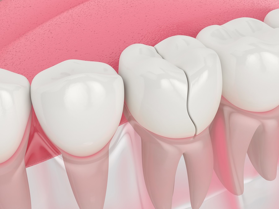Can a cracked tooth cure on its own?