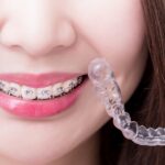 The Use And Application Of Tooth Retainers