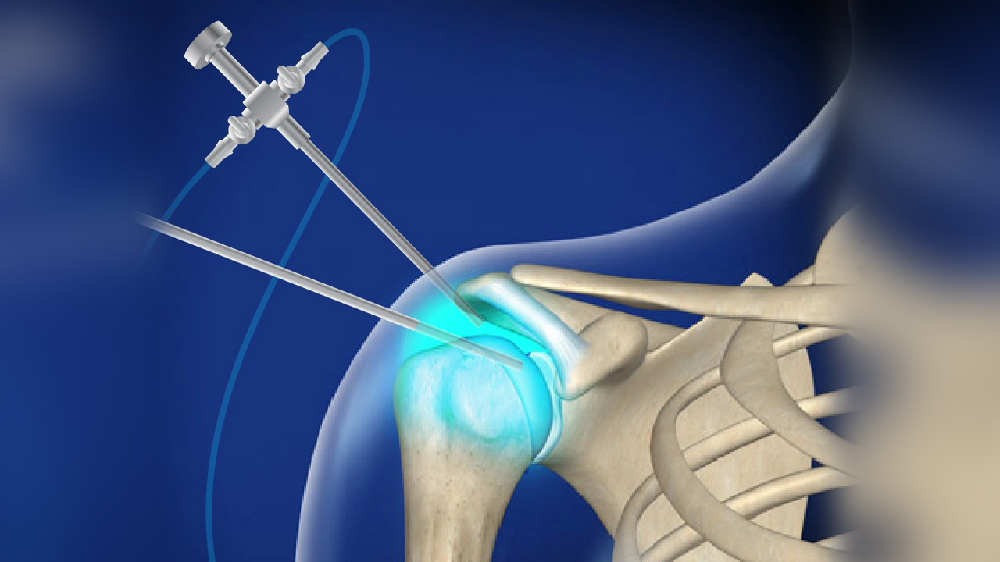 All you need to know about shoulders arthroscopy