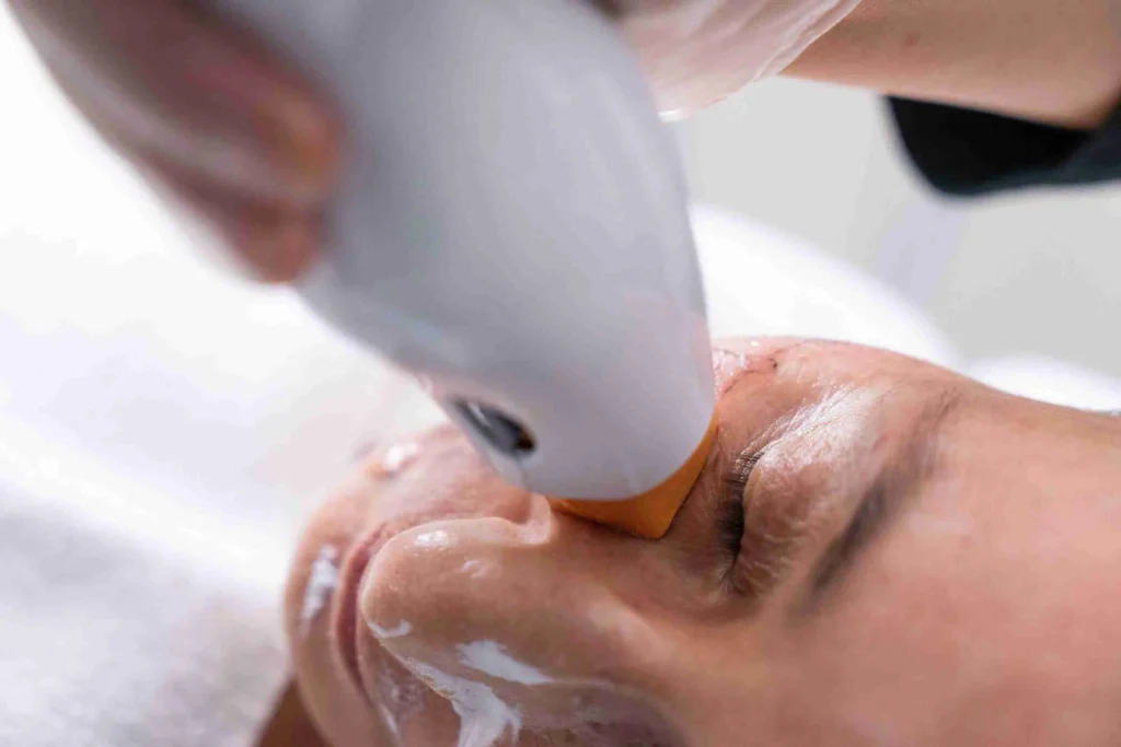 Thermage FLX Results Take Time But Give You Long Lasting Younger Looking Skin 